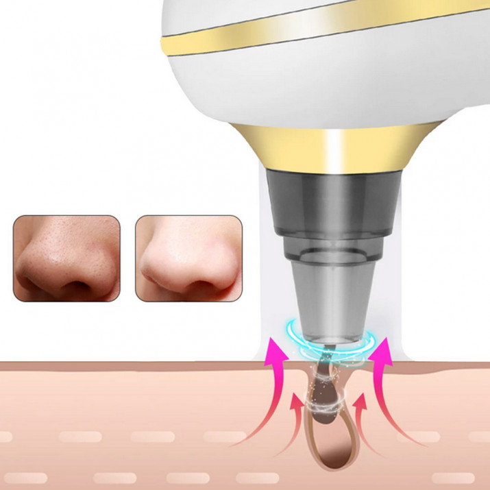 Mini mitesszer eltávolító (3)